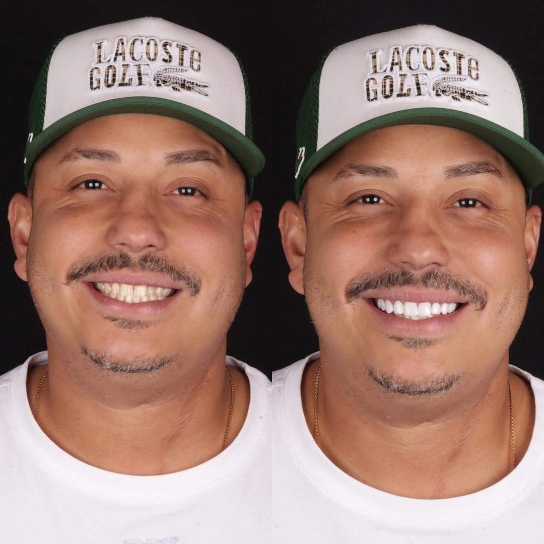 Facetas e lentes de contato