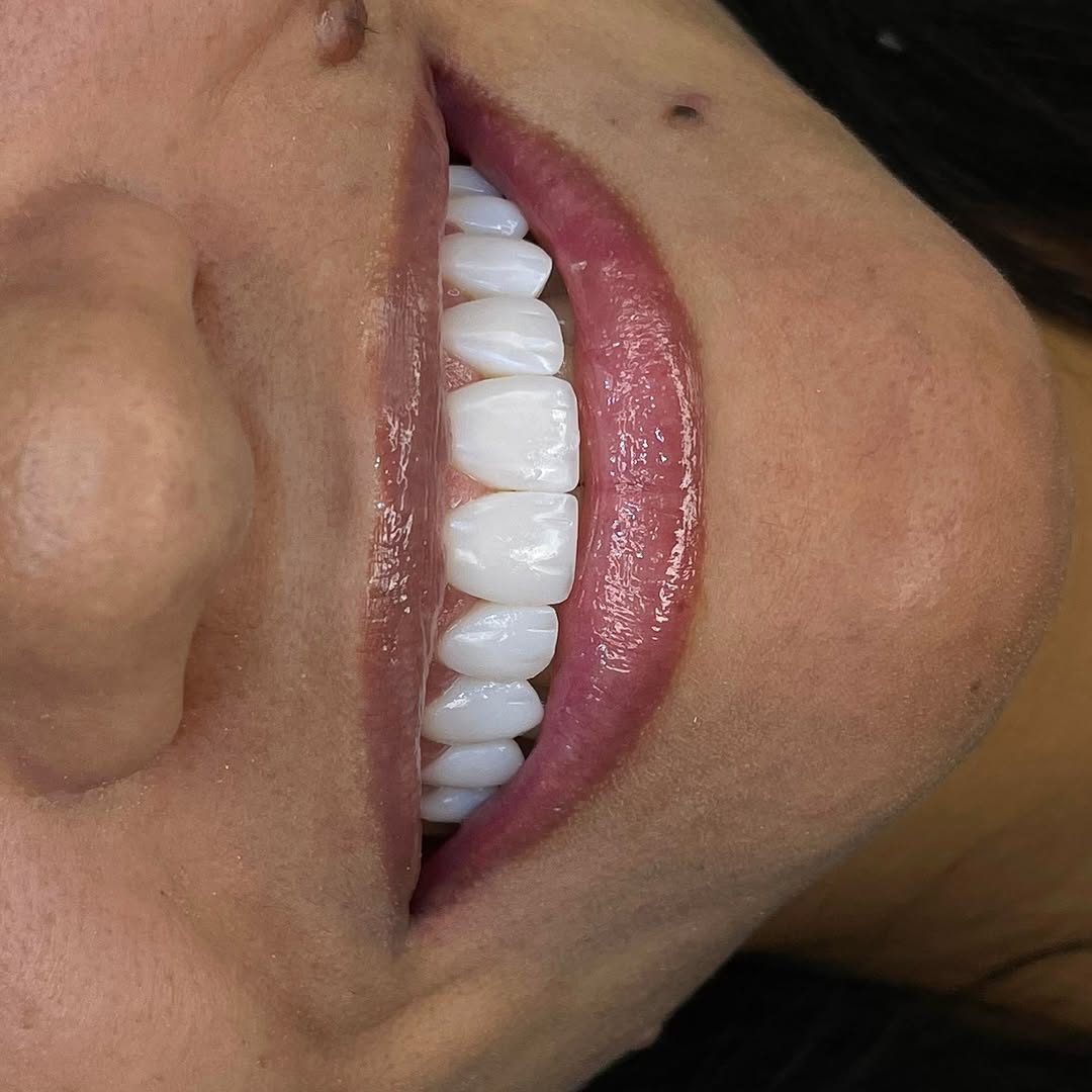 Clareamento dental